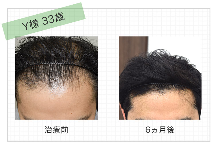 発毛事例